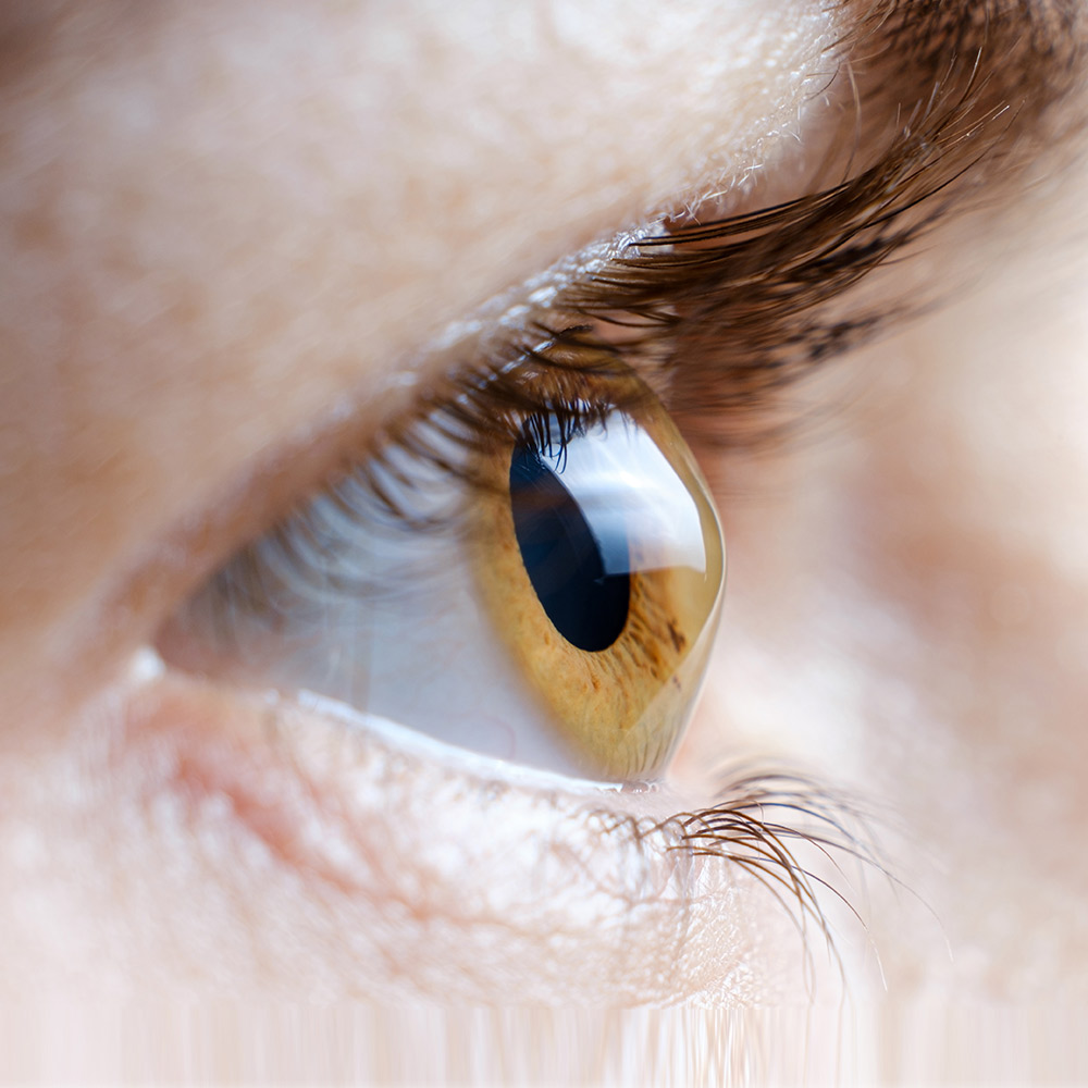 Keratoconus Treatment in Lexington